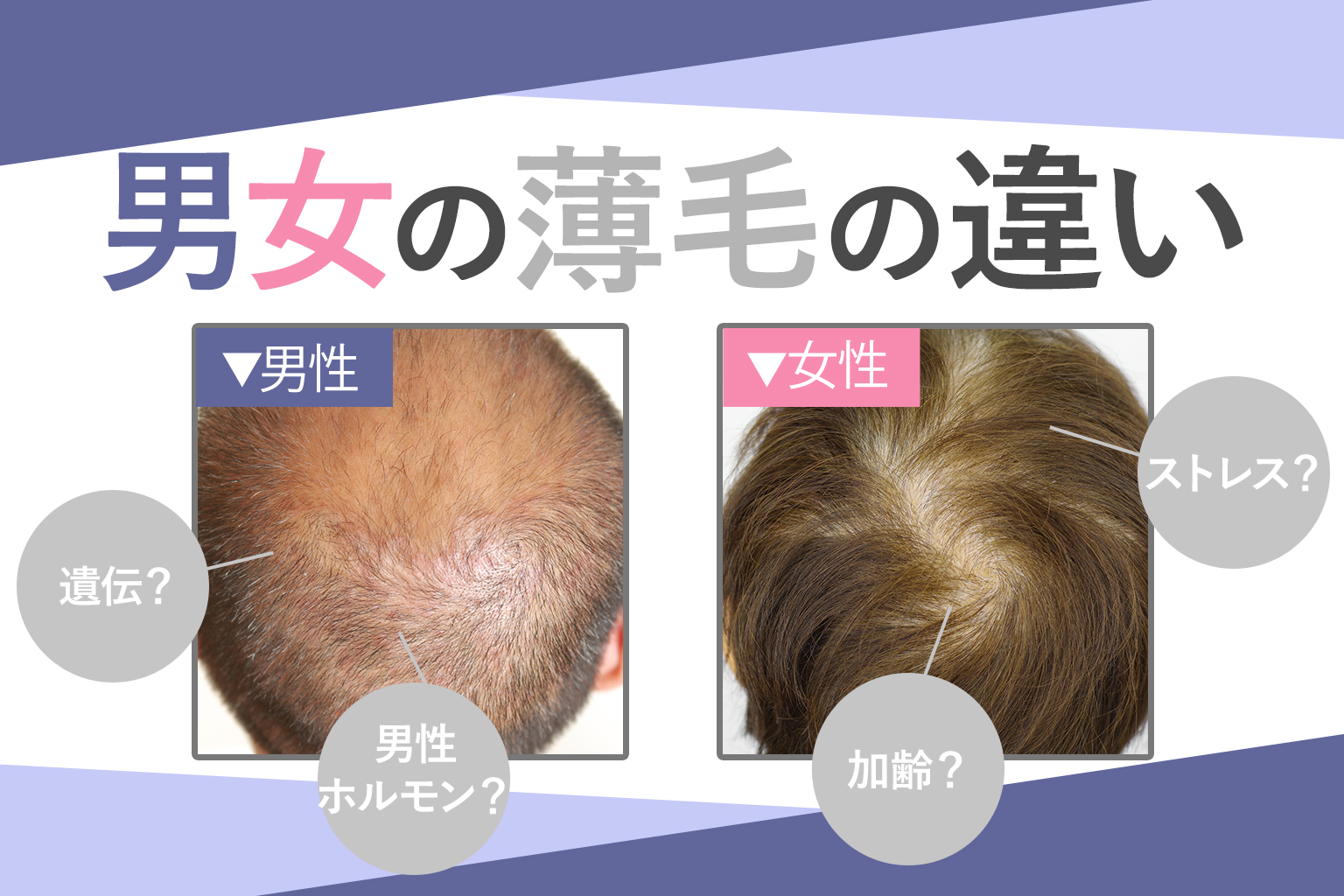 【男女の薄毛の違い】原因から特徴、対策まで徹底解説