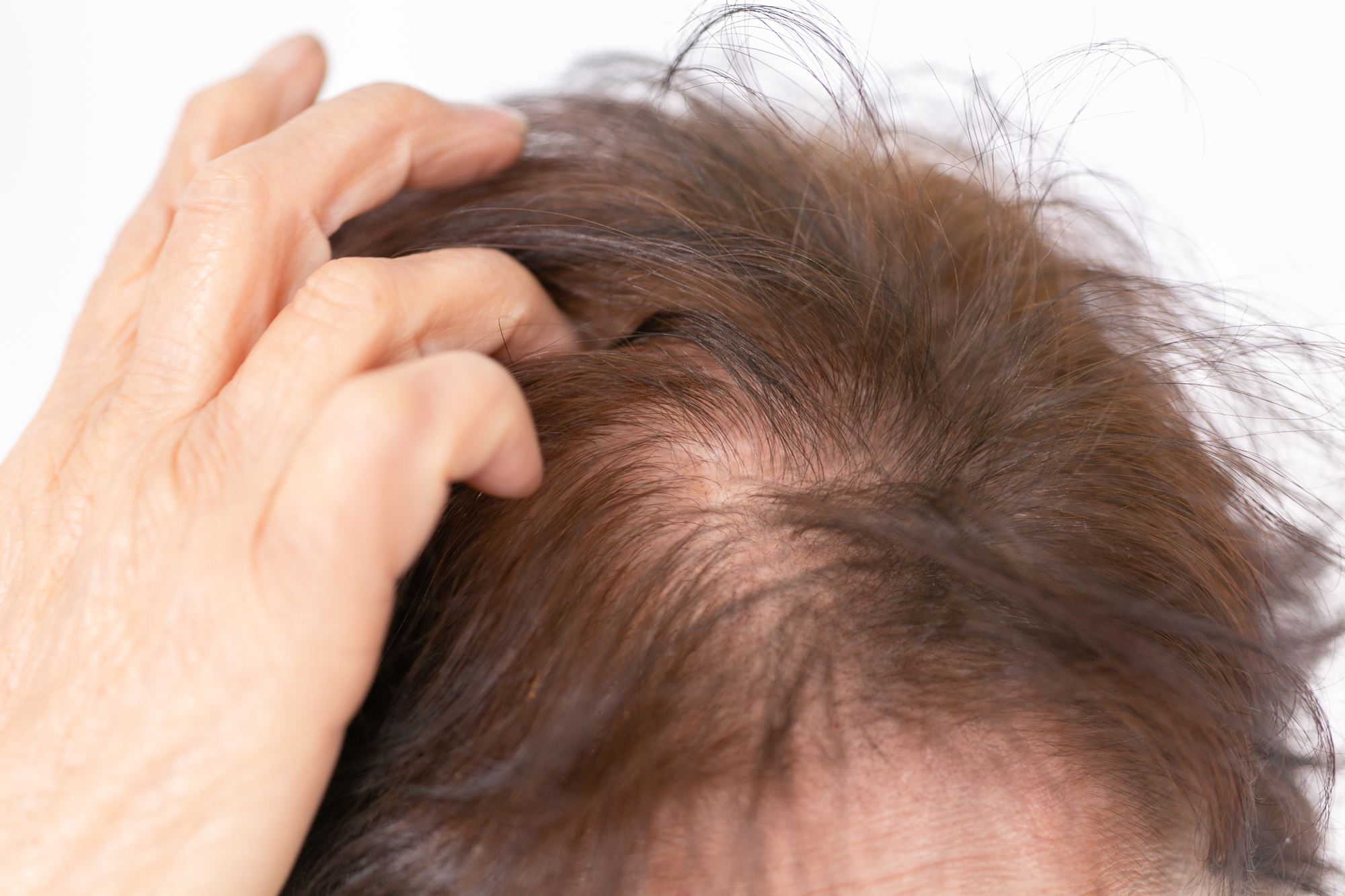 【決定版】女性の薄毛の原因はコレだった！年代別・原因別の徹底解説と今日からできる対策