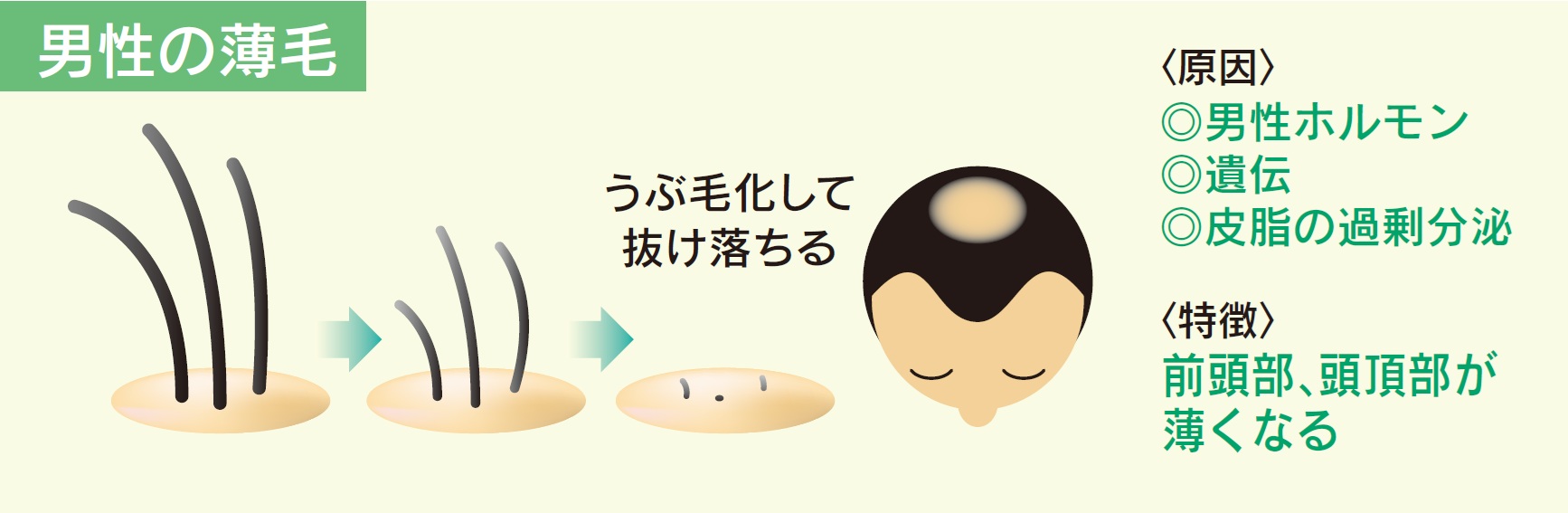 男性の薄毛（男性型脱毛症）