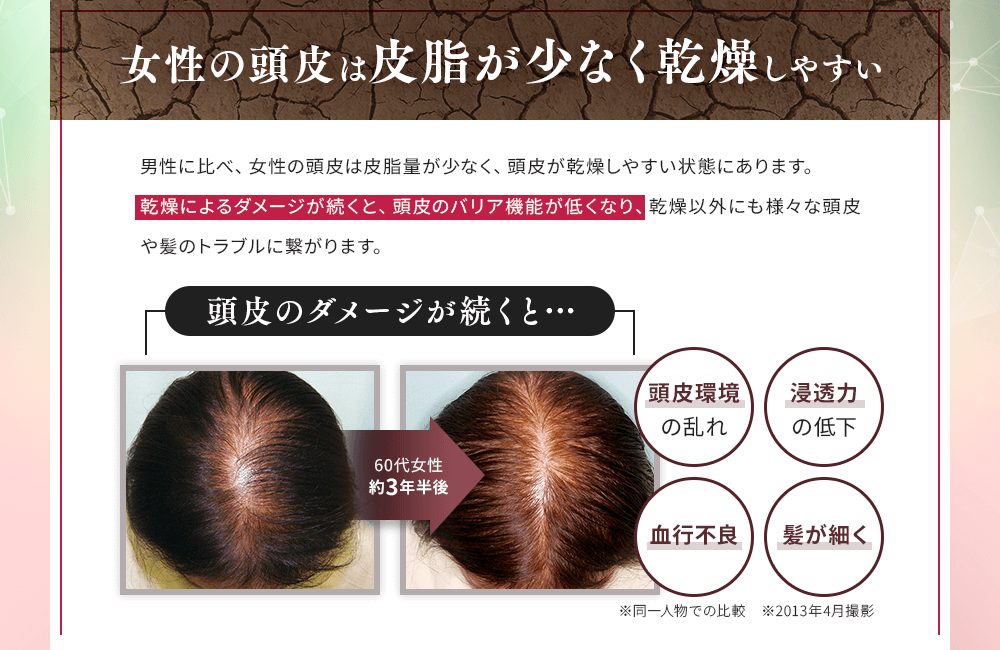 女性の頭皮は皮脂が少なく乾燥しやすい